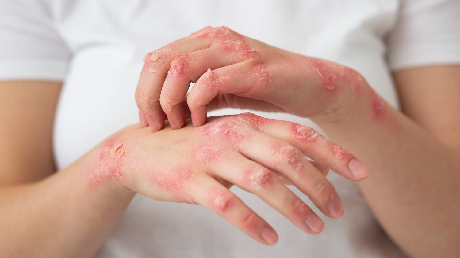 Is eczema contagious? Myths and facts
