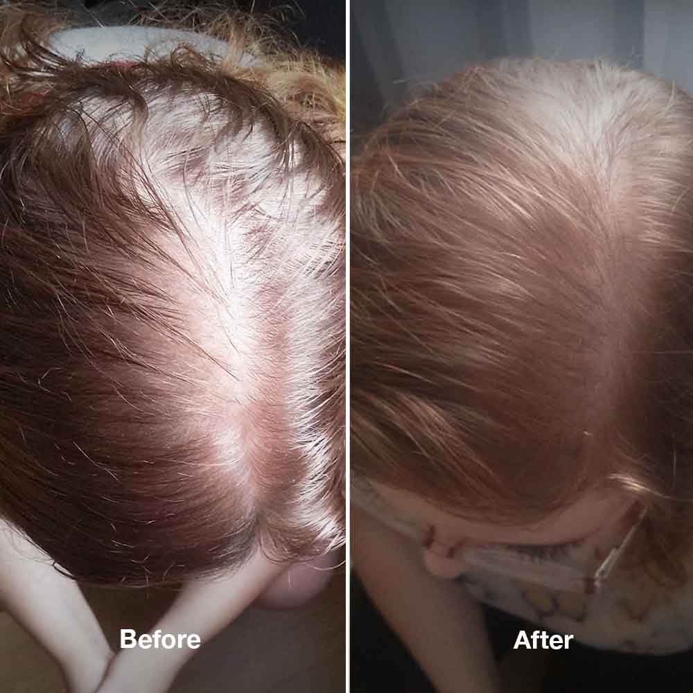 4-Step HairLXR Set + FREE Head Brush
