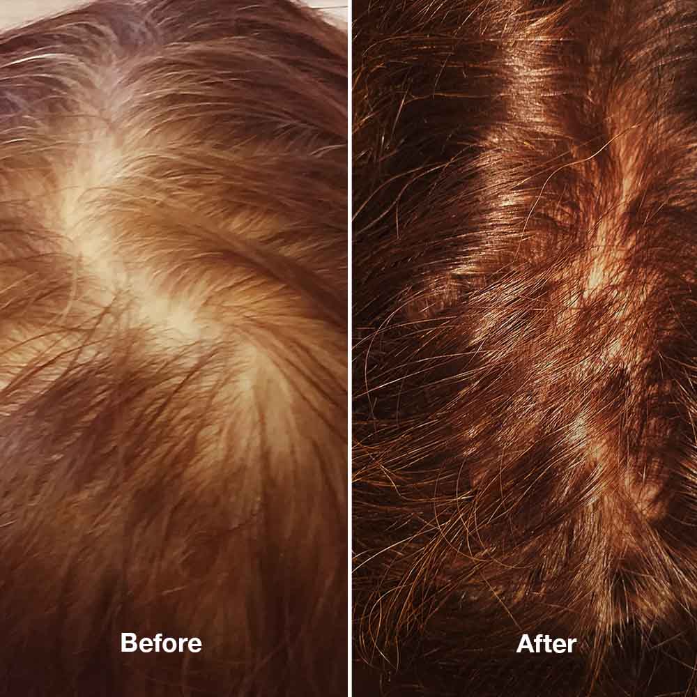 4-Step HairLXR Set + FREE Head Brush