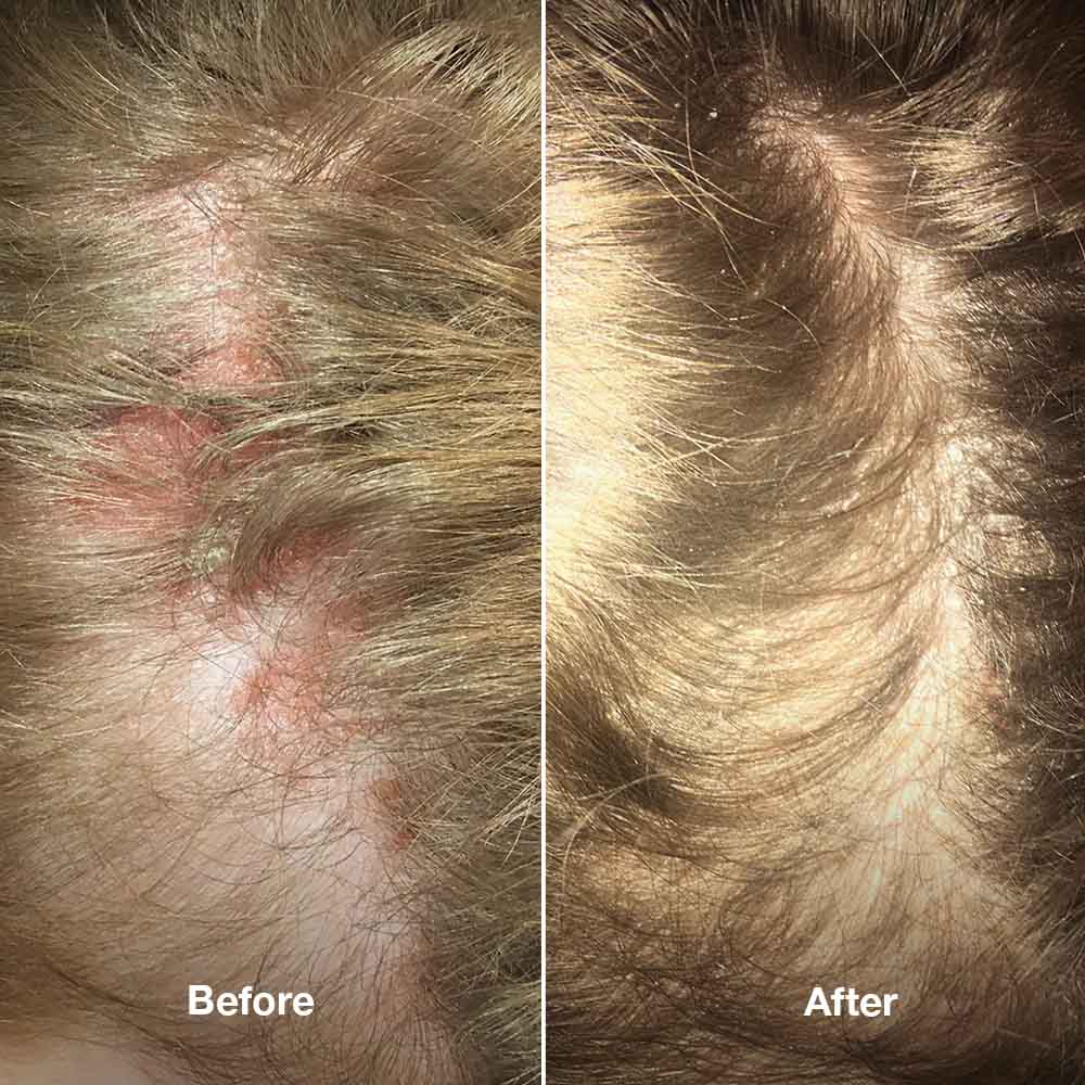 Healpsorin Scalp and Hair Set +FREE Scalp Brush