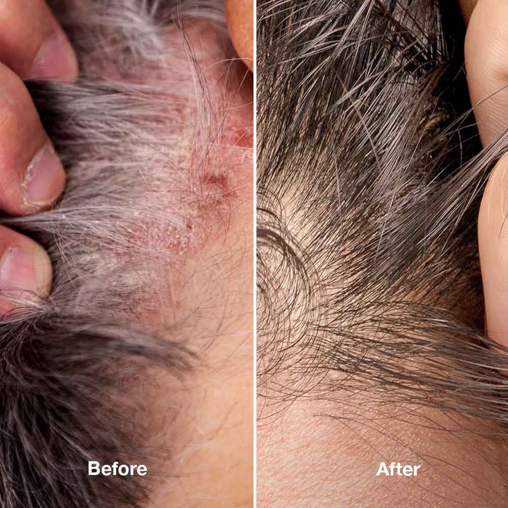 Healpsorin Scalp and Hair Set +FREE Scalp Brush