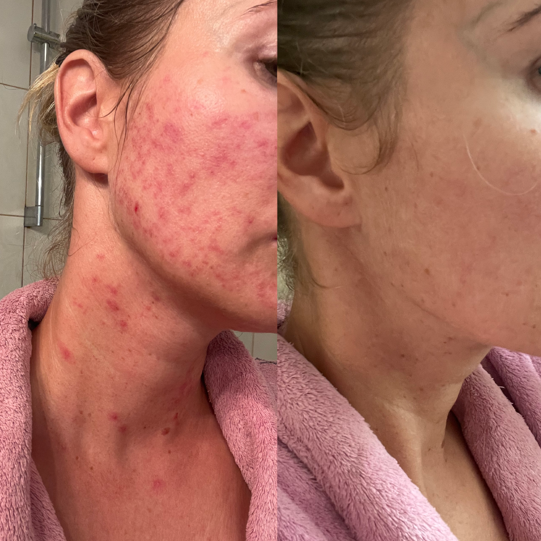 Vitumisil Anti-Acne Set