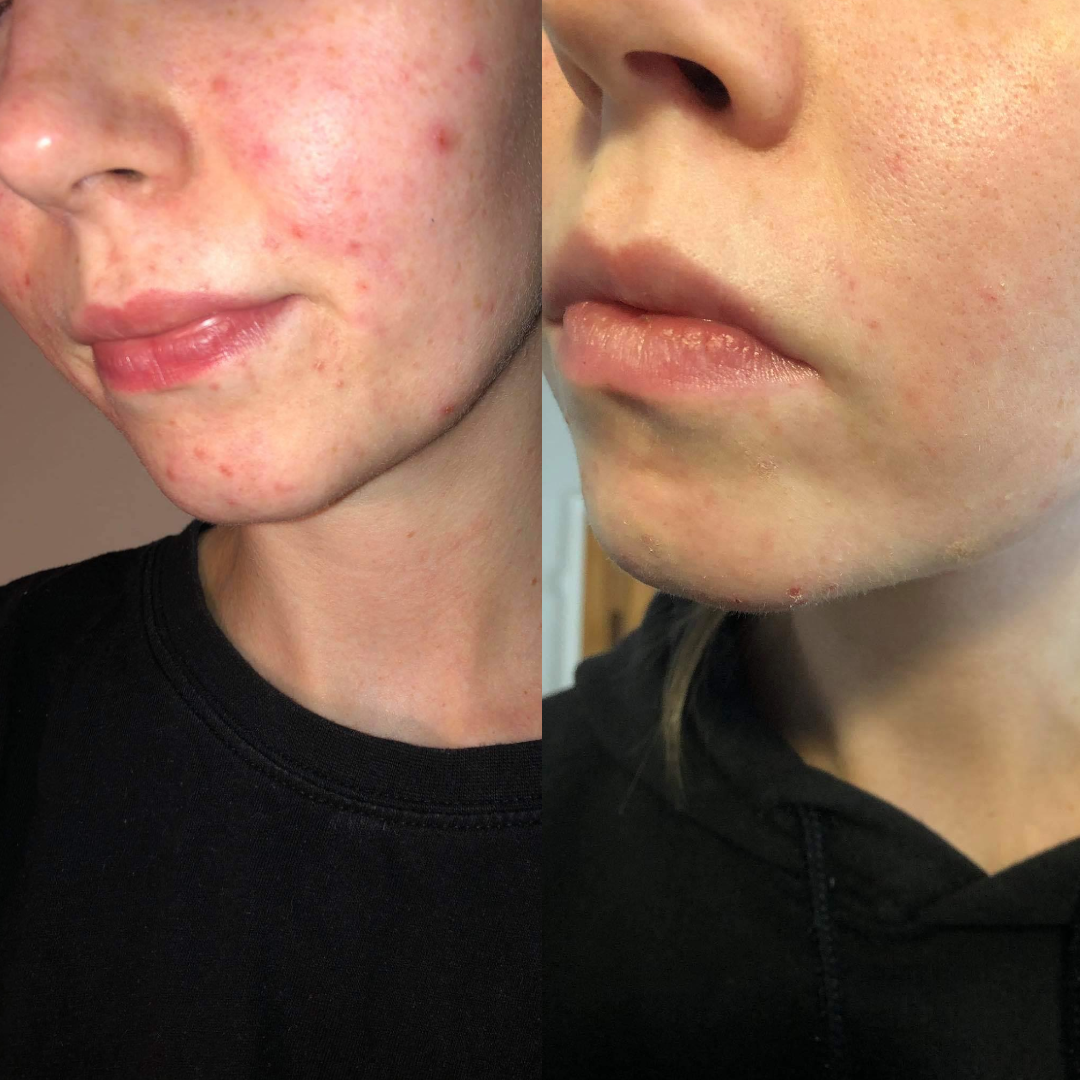 Vitumisil Anti-Acne Set