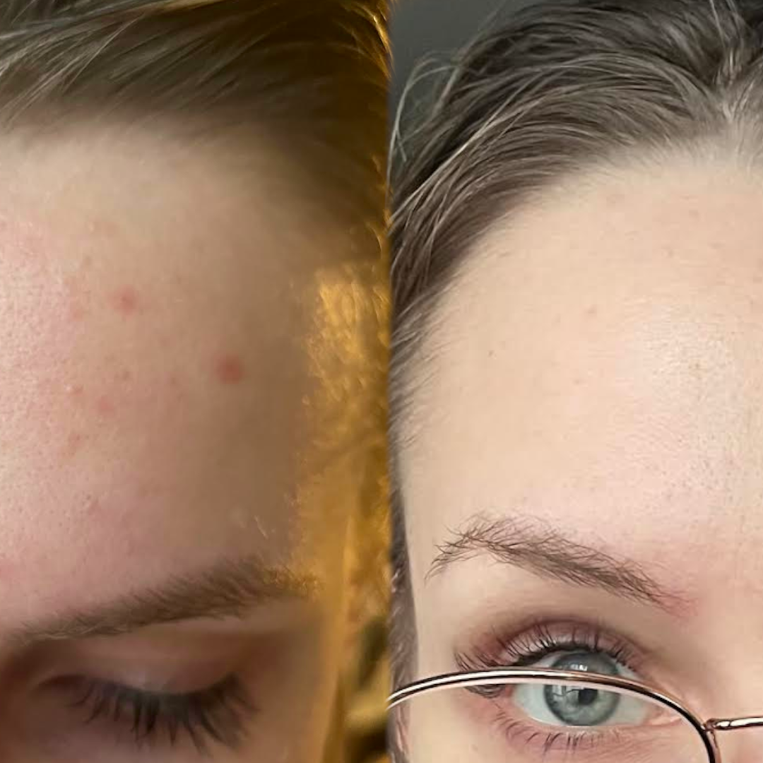 Vitumisil Anti-Acne Set + Free Dermz Headband