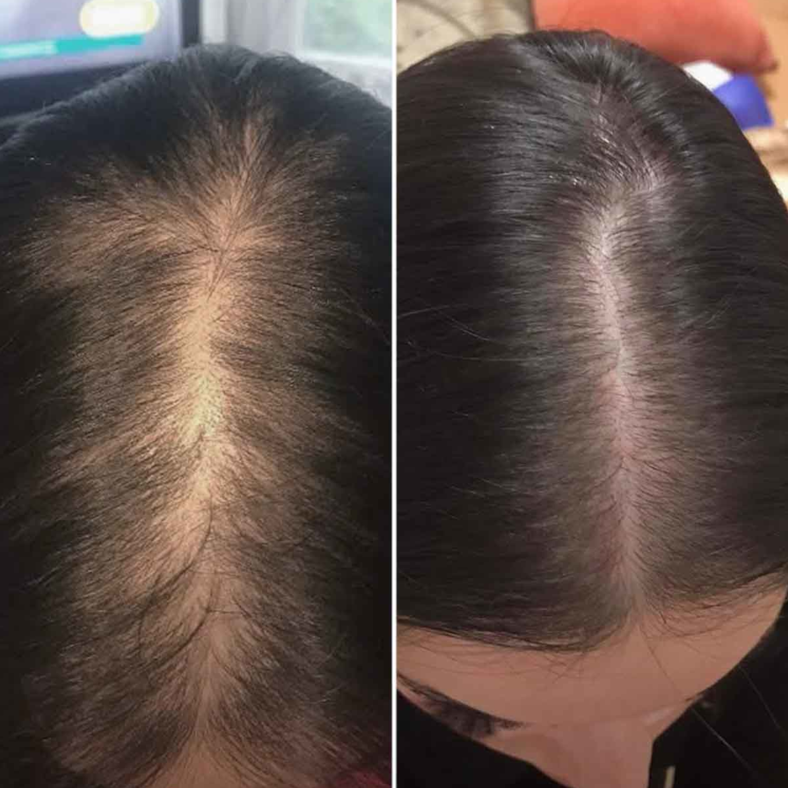 4-Stufen-HairLXR-Set + Gratis-Serum