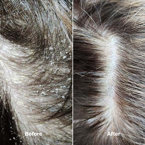 Healpsorin Scalp & Hair Set + FREE Body Wash