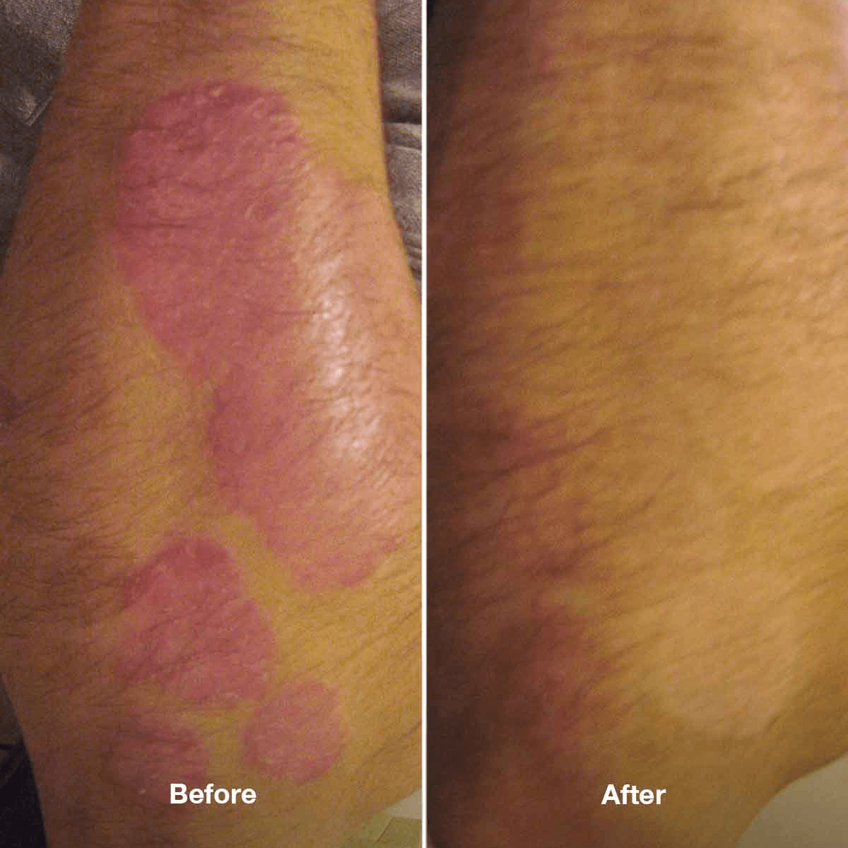 Healpsorin Emollient Balm