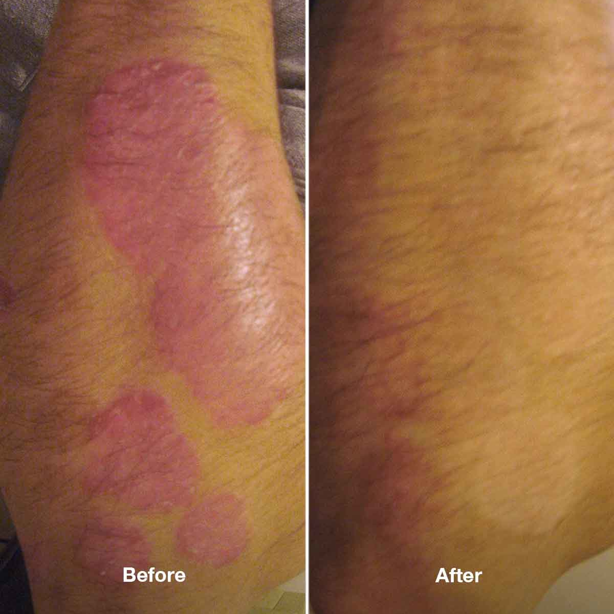Special Offer: Healpsorin Soothe & Protect Set + Free Soap