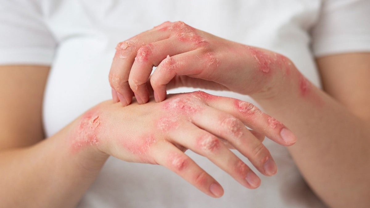 Is eczema contagious? Myths and facts